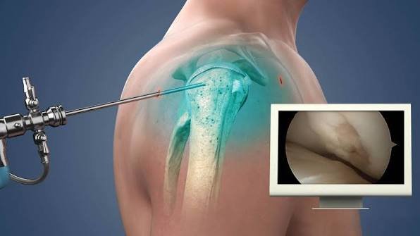 Joint Replacement In Nagpur