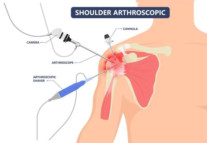 Shoulder Arthroscopy In Narsinghpur