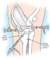 Shoulder Arthroscopy In Rewa