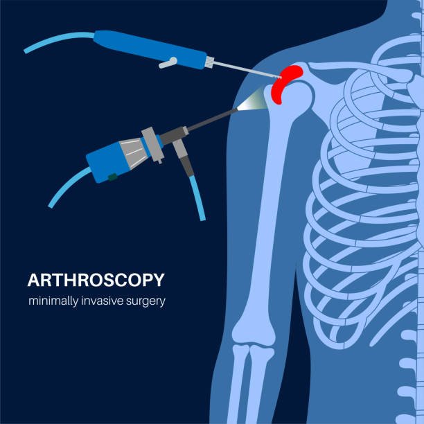 Shoulder Arthroscopy In Satna