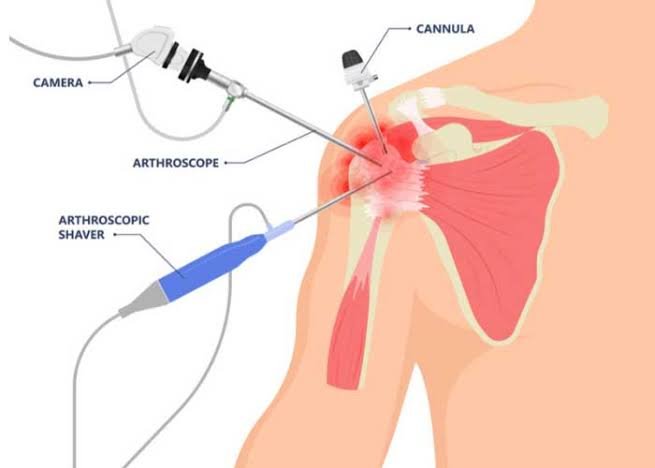 Shoulder Arthroscopy In Seoni