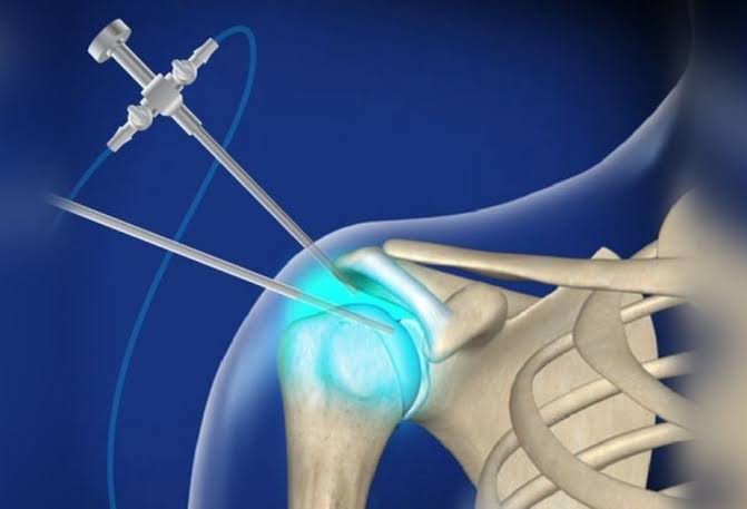 Shoulder Arthroscopy In katni