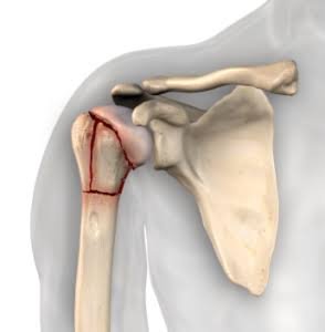 Shoulder Fracture In Nagpur