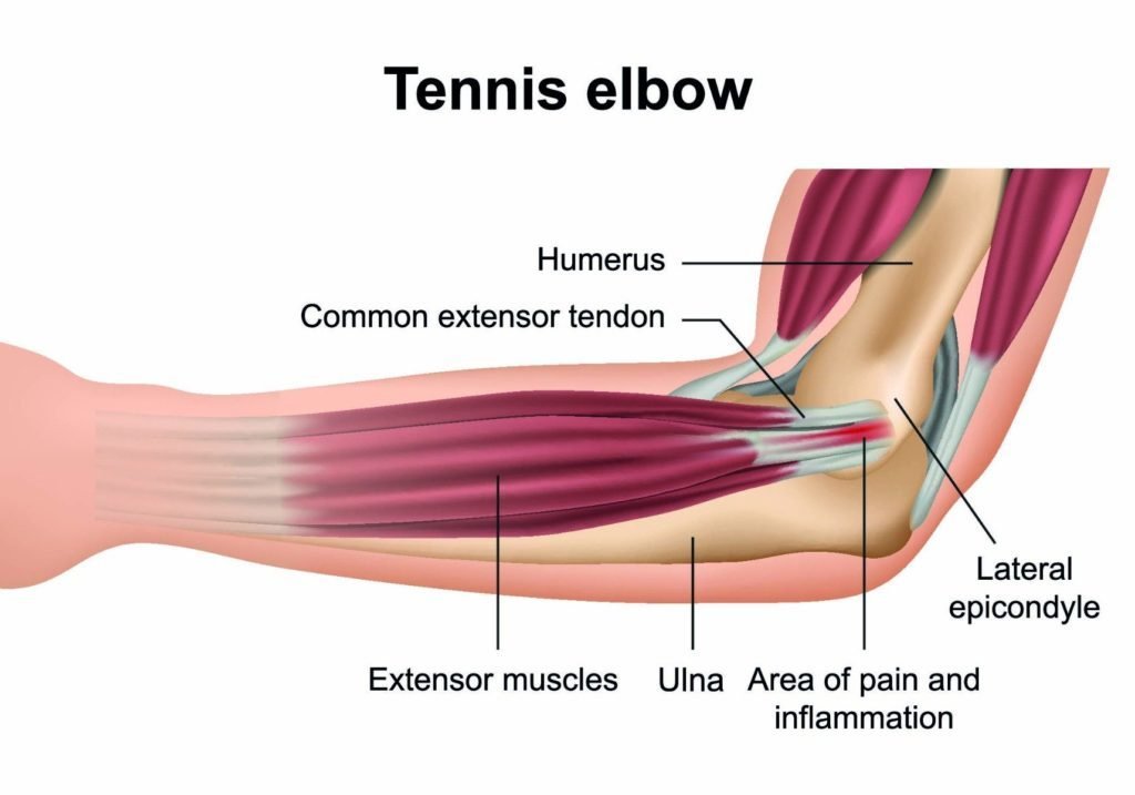 Tennis Elbow In Nagpur
