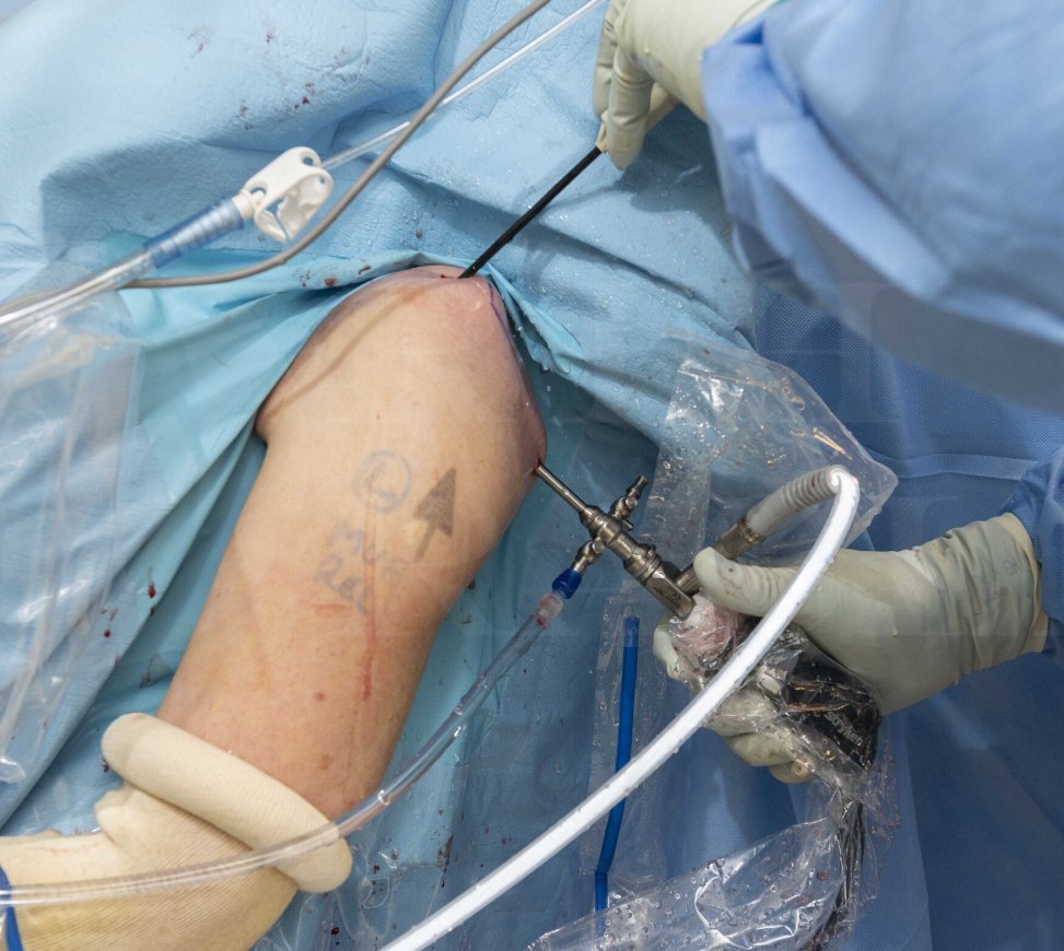 Shoulder Arthroscopy In Yavatmal